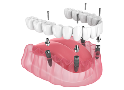 Full Arch Dental implant in Chattanooga, TN, at St. Elmo Dental