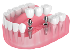 Implant-supported bridge: Dental implants in Chattanooga, TN, at St. Elmo Dental