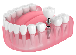 Single Tooth Implant: Dental implants in Chattanooga, TN, at St. Elmo Dental