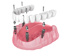 Fixed Denture in Chattanooga, TN, at St. Elmo Dental