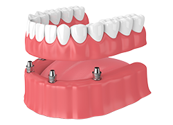 Snap-in Denture in Chattanooga, TN, at St. Elmo Dental